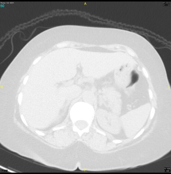 File:Breast primary with lung and bone metastases (Radiopaedia 40620-43228 Axial lung window 50).jpg