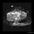 Broad ligament fibroid (Radiopaedia 49135-54241 Axial ADC 14).jpg