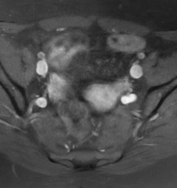 File:Broad ligament leiomyoma (Radiopaedia 81634-95516 Axial T1 C+ fat sat 9).jpg