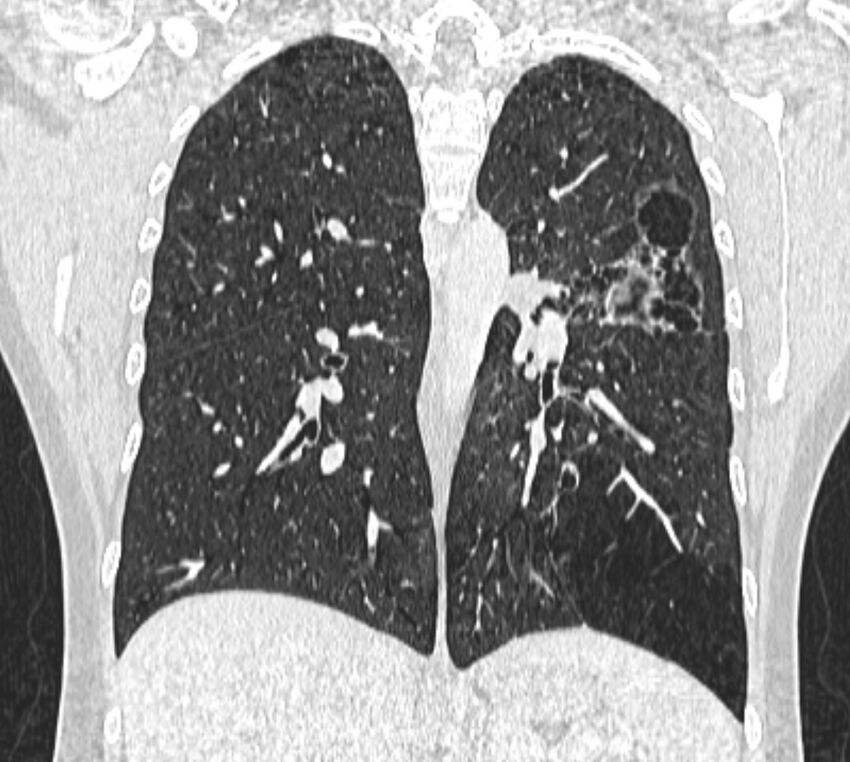 Bronchial atresia (Radiopaedia 50007-55297 Coronal lung window 69).jpg