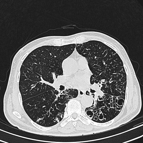 File:Bronchiectasis (Radiopaedia 22061-22059 lung window 16).jpg
