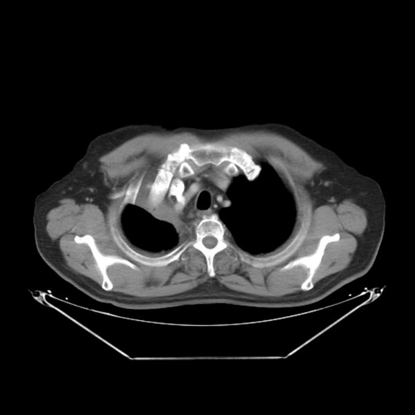 File:Bronchogenic carcinoma with upper lobe collapse (Radiopaedia 29297-29726 C 7).jpg