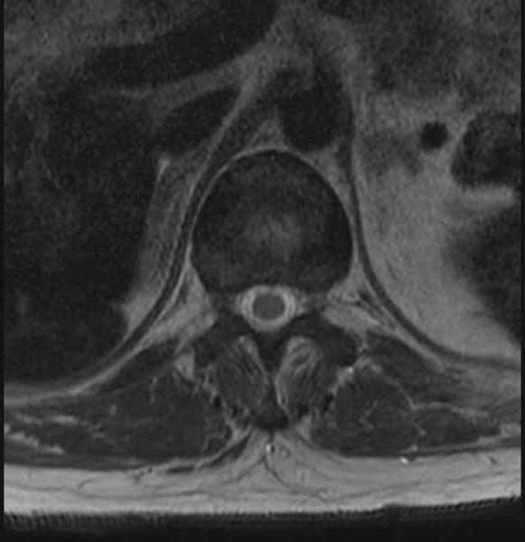 File:Brown tumors compressing the spinal cord (Radiopaedia 68442-78030 A 4).jpg