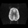 Burkitt lymphoma of the orbit- pre and post chemotherapy (Radiopaedia 31214-31930 Axial DWI 12).jpg
