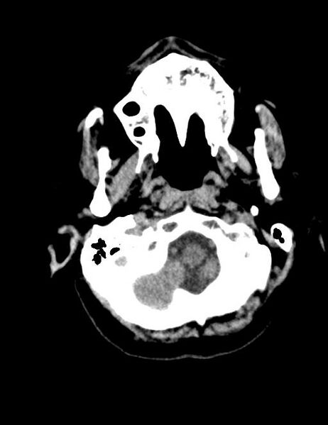 File:Burnt-out meningioma (Radiopaedia 51557-57337 Axial non-contrast 1).jpg