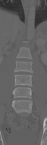 File:Burst fracture - T12 with conus compression (Radiopaedia 56825-63647 Coronal bone window 14).png