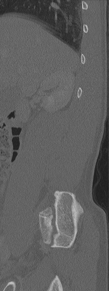 File:Burst fracture - T12 with conus compression (Radiopaedia 56825-63647 Sagittal bone window 77).png