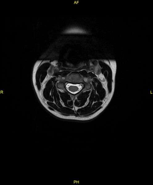 File:C5 nerve sheath tumor (Radiopaedia 85777-101596 Axial T2 15).jpg