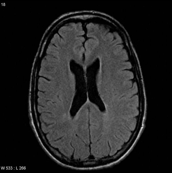 File:CMV ventriculitis and encephalitis (Radiopaedia 5416-7166 Axial FLAIR 6).jpg