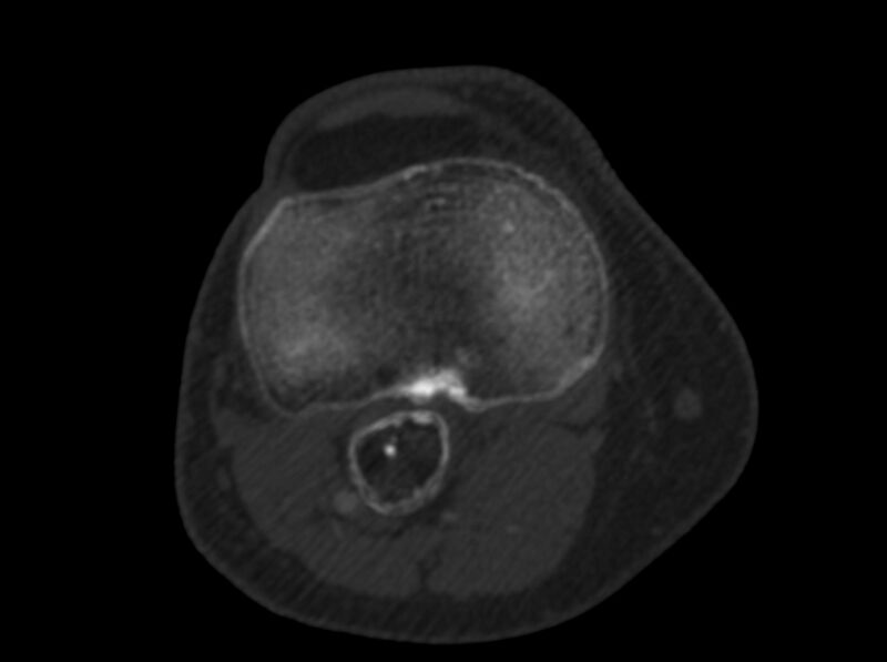File:Calcified hematoma - popliteal fossa (Radiopaedia 63938-72763 C 39).jpg