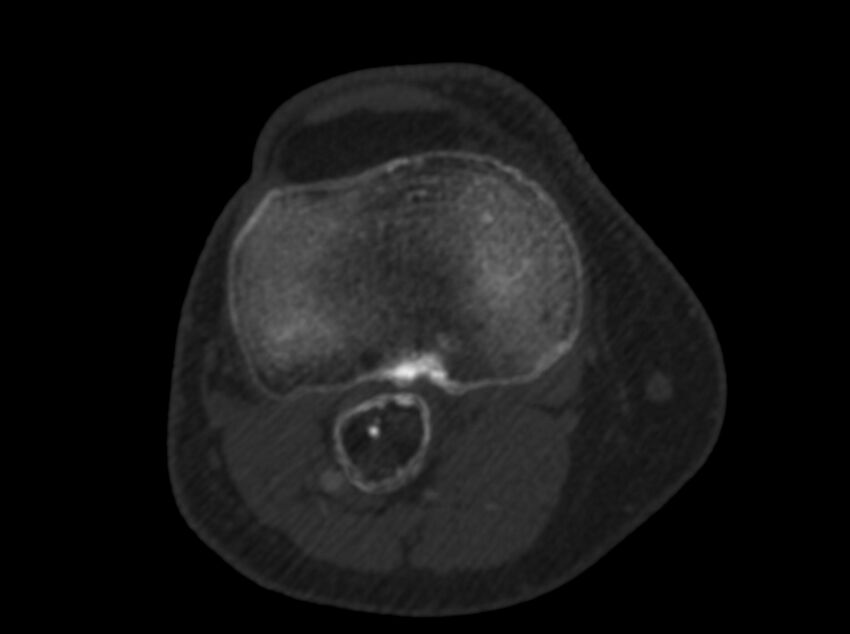 Calcified hematoma - popliteal fossa (Radiopaedia 63938-72763 C 39).jpg