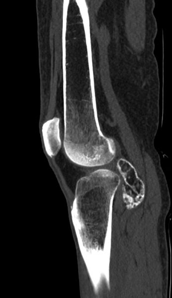 File:Calcified hematoma - popliteal fossa (Radiopaedia 63938-72763 Sagittal bone window 75).jpg