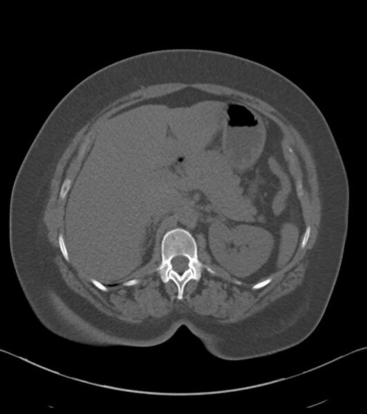 File:Calcified hepatic hydatid cyst (Radiopaedia 81127-94738 Axial non-contrast 31).jpg
