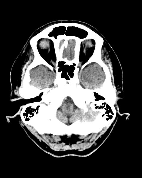 File:Calcified meningioma (Radiopaedia 74361-85243 Axial non-contrast 42).jpg