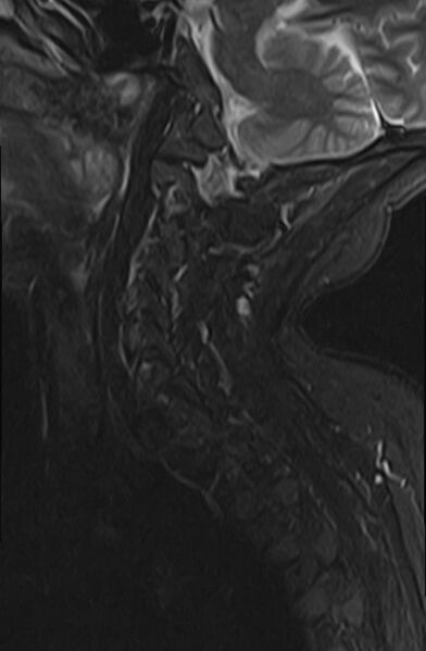 File:Calcified meningioma - cervical canal (Radiopaedia 70136-82468 Sagittal STIR 4).jpg