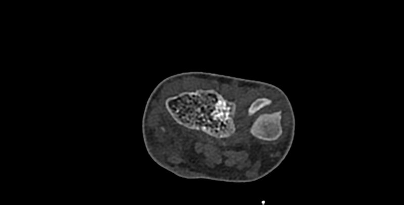 File:Calcifying aponeurotic fibroma (Radiopaedia 88423-105064 Axial bone window 32).jpg