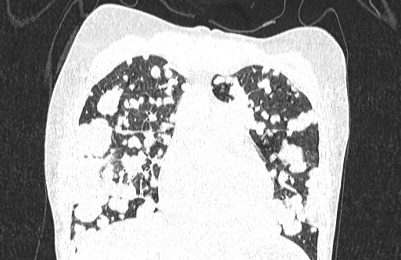File:Cannonball metastases from breast cancer (Radiopaedia 91024-108569 Coronal lung window 48).jpg
