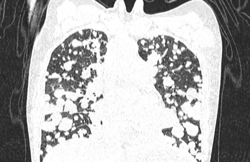File:Cannonball metastases from breast cancer (Radiopaedia 91024-108569 Coronal lung window 60).jpg