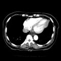 Cardiac fibroma (Radiopaedia 38974-41149 A 15).jpg