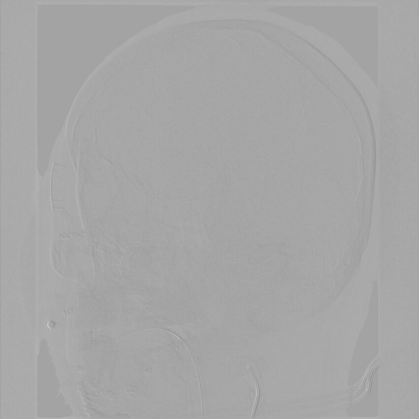 Caroticocavernous fistula - direct (Radiopaedia 61660-69666 Oblique Left ICA 3).jpg