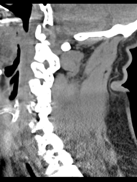 File:Cavernoma of cervical cord (Radiopaedia 50838-56346 B 33).png