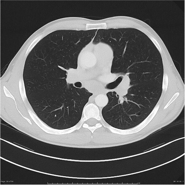File:Cavitating lung cancer (Radiopaedia 25796-25945 Axial lung window 26).jpg