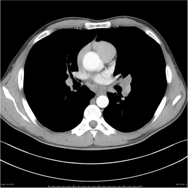 File:Cavitating lung cancer (Radiopaedia 25796-25945 C+ arterial phase 29).jpg