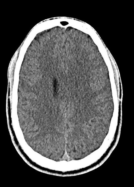 File:Cavum septum pellucidum and cavum vergae (Radiopaedia 77797-90060 Axial Brain Window 69).jpg