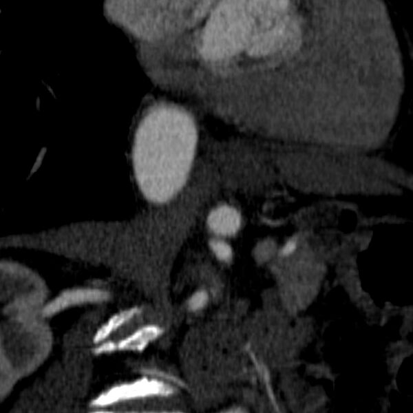 File:Celiac artery aneurysm (Radiopaedia 21574-21525 B 7).JPEG