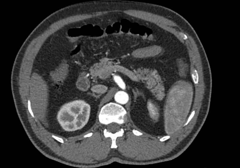 File:Celiac artery dissection (Radiopaedia 52194-58080 A 32).jpg