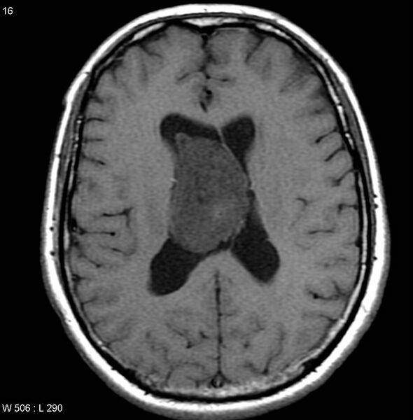 File:Central neurocytoma (Radiopaedia 4956-6850 Axial T1 1).jpg