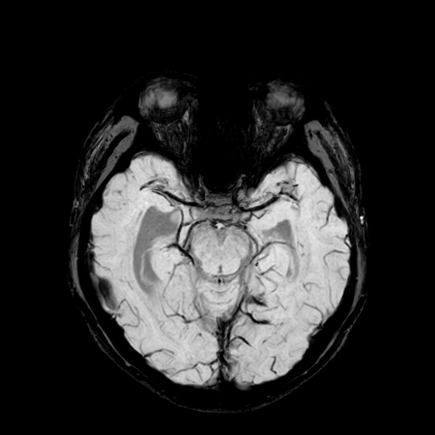 Central neurocytoma (Radiopaedia 79320-92380 Axial SWI 50).jpg