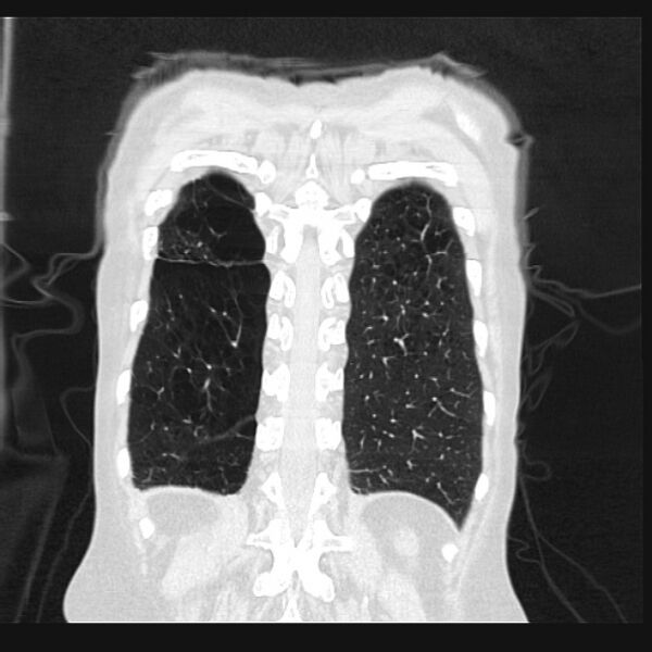 File:Centrilobular pulmonary emphysema (Radiopaedia 24495-24789 Coronal lung window 66).jpg