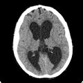 Cerebellar abscess secondary to mastoiditis (Radiopaedia 26284-26412 Axial non-contrast 84).jpg