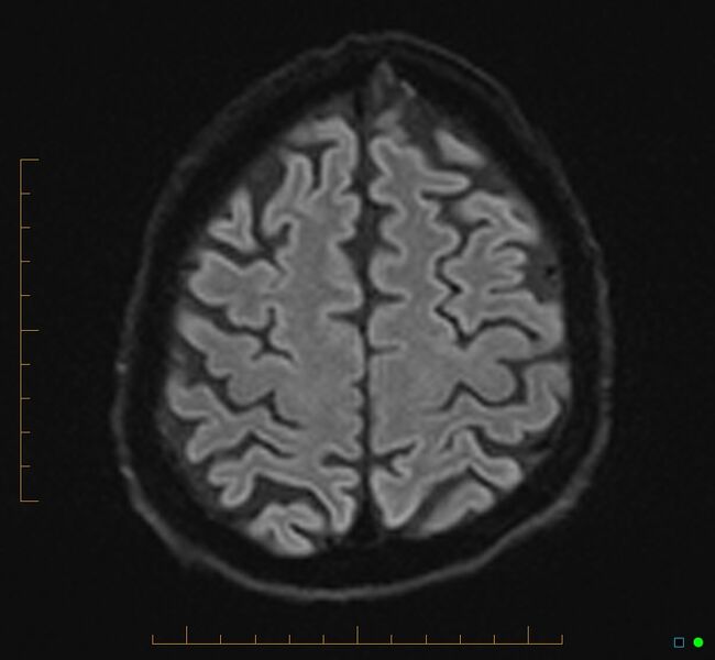 File:Cerebellar gangliocytoma (Radiopaedia 65377-74422 Axial DWI 32).jpg