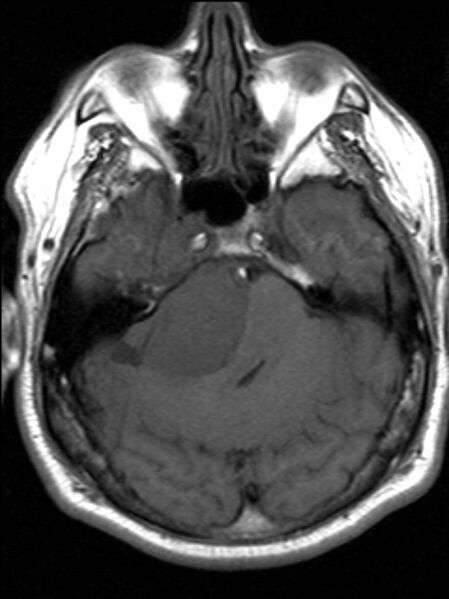 File:Cerebellopontine angle meningioma (Radiopaedia 24459-24764 Axial T1 6).jpg