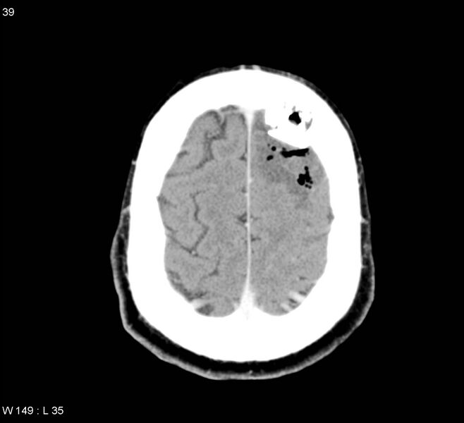 File:Cerebral abscess (Radiopaedia 5150-6933 Axial C+ delayed 8).jpg