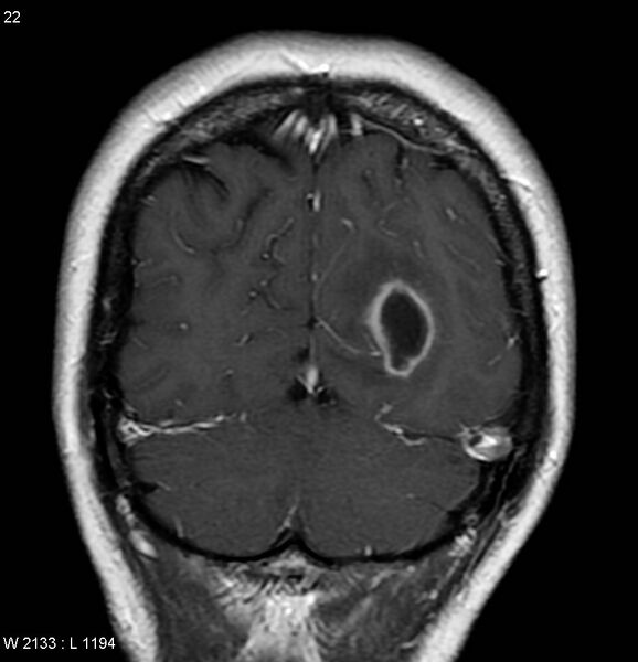 File:Cerebral abscess - shaggy borders (Radiopaedia 5492-7225 Coronal T1 C+ 1).jpg