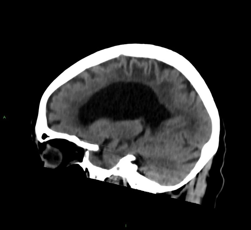 Cerebral amyloid angiopathy-associated lobar intracerebral hemorrhage (Radiopaedia 58376-65513 C 45).jpg