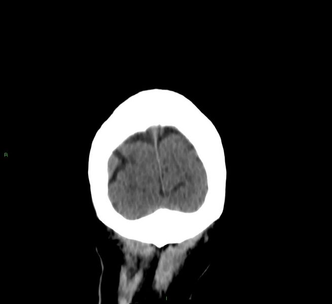 File:Cerebral amyloid angiopathy-associated lobar intracerebral hemorrhage (Radiopaedia 58376-65513 Coronal non-contrast 18).jpg