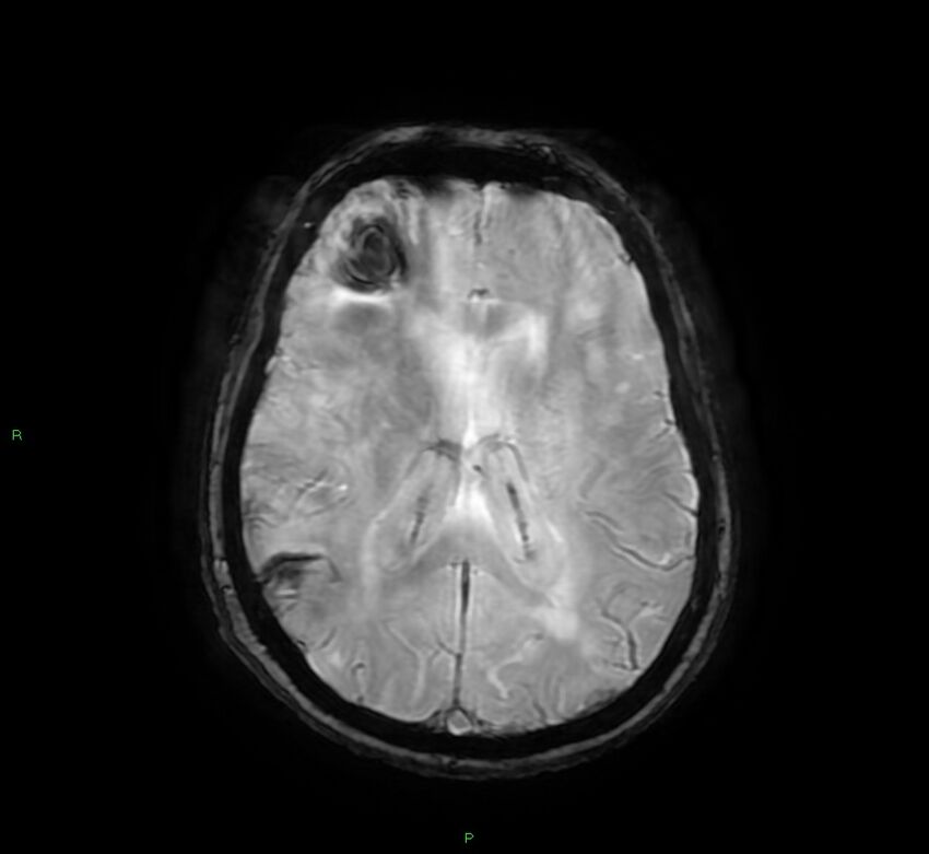 Cerebral amyloid angiopathy-associated lobar intracerebral hemorrhage (Radiopaedia 58378-65517 Axial SWI 43).jpg
