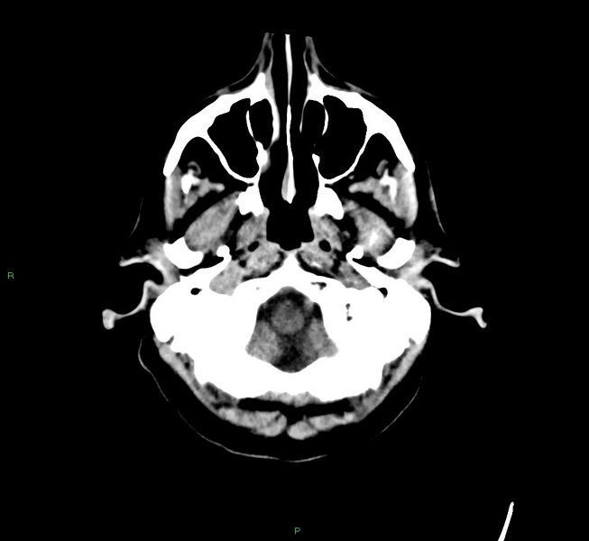 File:Cerebral amyloid angiopathy-associated lobar intracerebral hemorrhage (Radiopaedia 58529-65681 Axial non-contrast 47).jpg