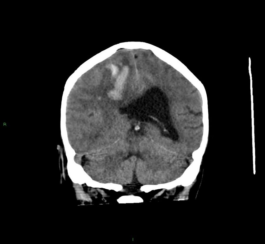Cerebral amyloid angiopathy-associated lobar intracerebral hemorrhage (Radiopaedia 58560-65723 Coronal non-contrast 28).jpg