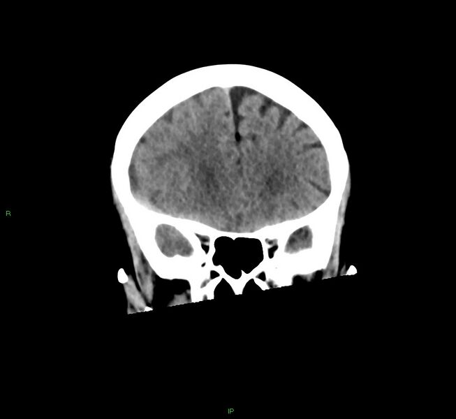 File:Cerebral amyloid angiopathy-associated lobar intracerebral hemorrhage (Radiopaedia 58563-65727 Coronal non-contrast 47).jpg