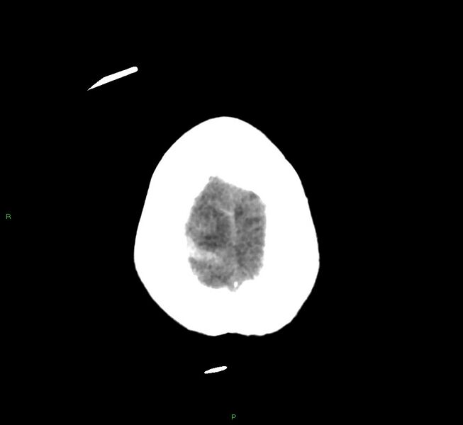 File:Cerebral amyloid angiopathy-associated lobar intracerebral hemorrhage (Radiopaedia 58566-65730 Axial non-contrast 6).jpg
