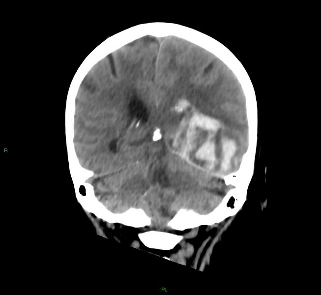 File:Cerebral amyloid angiopathy-associated lobar intracerebral hemorrhage (Radiopaedia 58754-65975 Coronal non-contrast 25).jpg