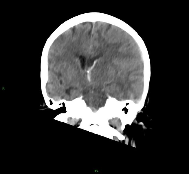 File:Cerebral amyloid angiopathy-associated lobar intracerebral hemorrhage (Radiopaedia 58754-65975 Coronal non-contrast 34).jpg