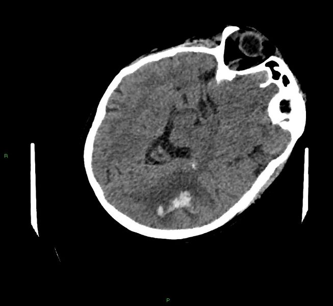File:Cerebral amyloid angiopathy-associated lobar intracerebral hemorrhage (Radiopaedia 58757-65979 Axial non-contrast 42).jpg