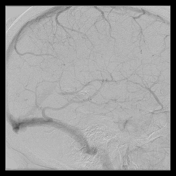 File:Cerebral aneurysm with rupture (Radiopaedia 29933-30458 LT ICA IC 49).jpg