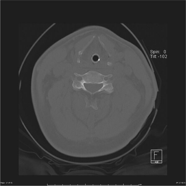 File:Cerebral hemorrhagic contusions and cervical spine fractures (Radiopaedia 32865-33841 C 17).jpg